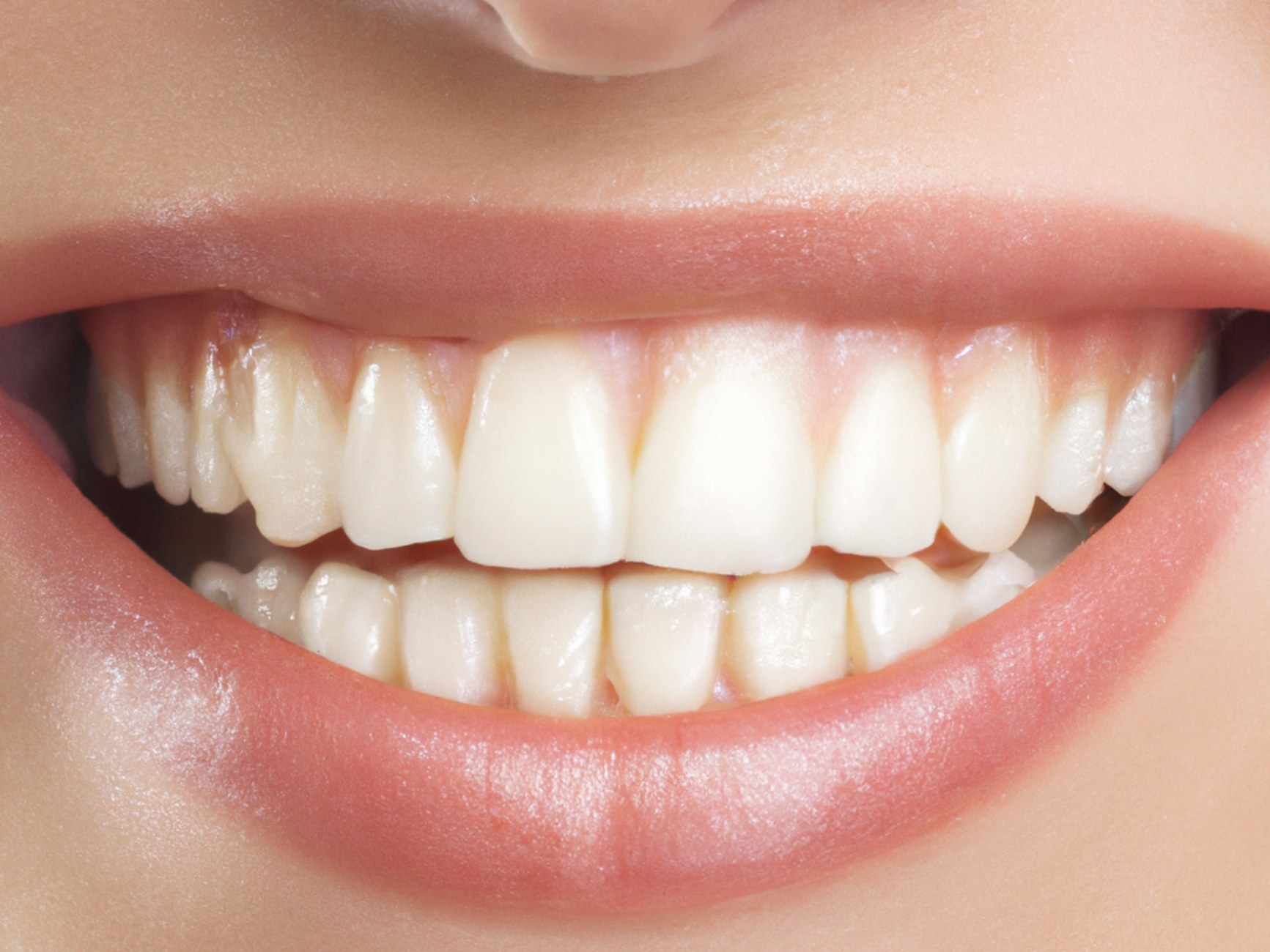 Close-up of a bright, natural white smile (sample image)